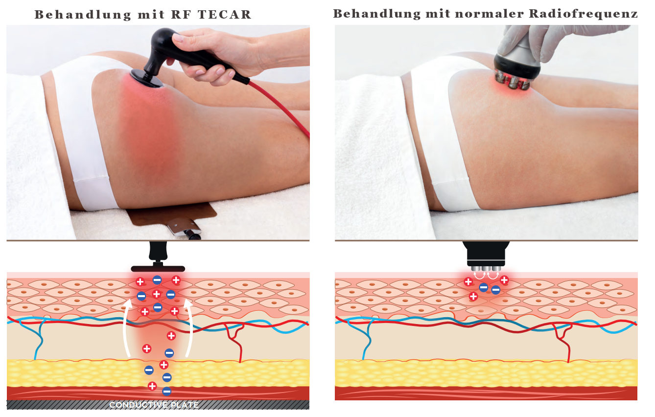 Unterschied zwischen RF TECAR Beauty und Antiaging Radiofrequenzbehandlungen
